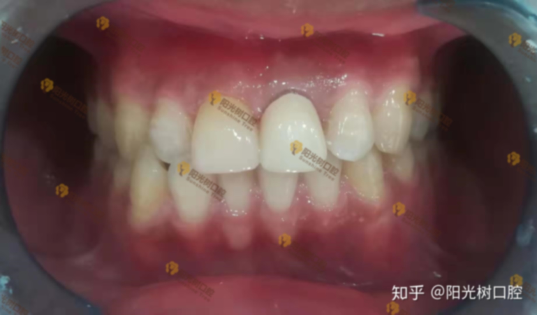 27岁做了16颗烤瓷牙