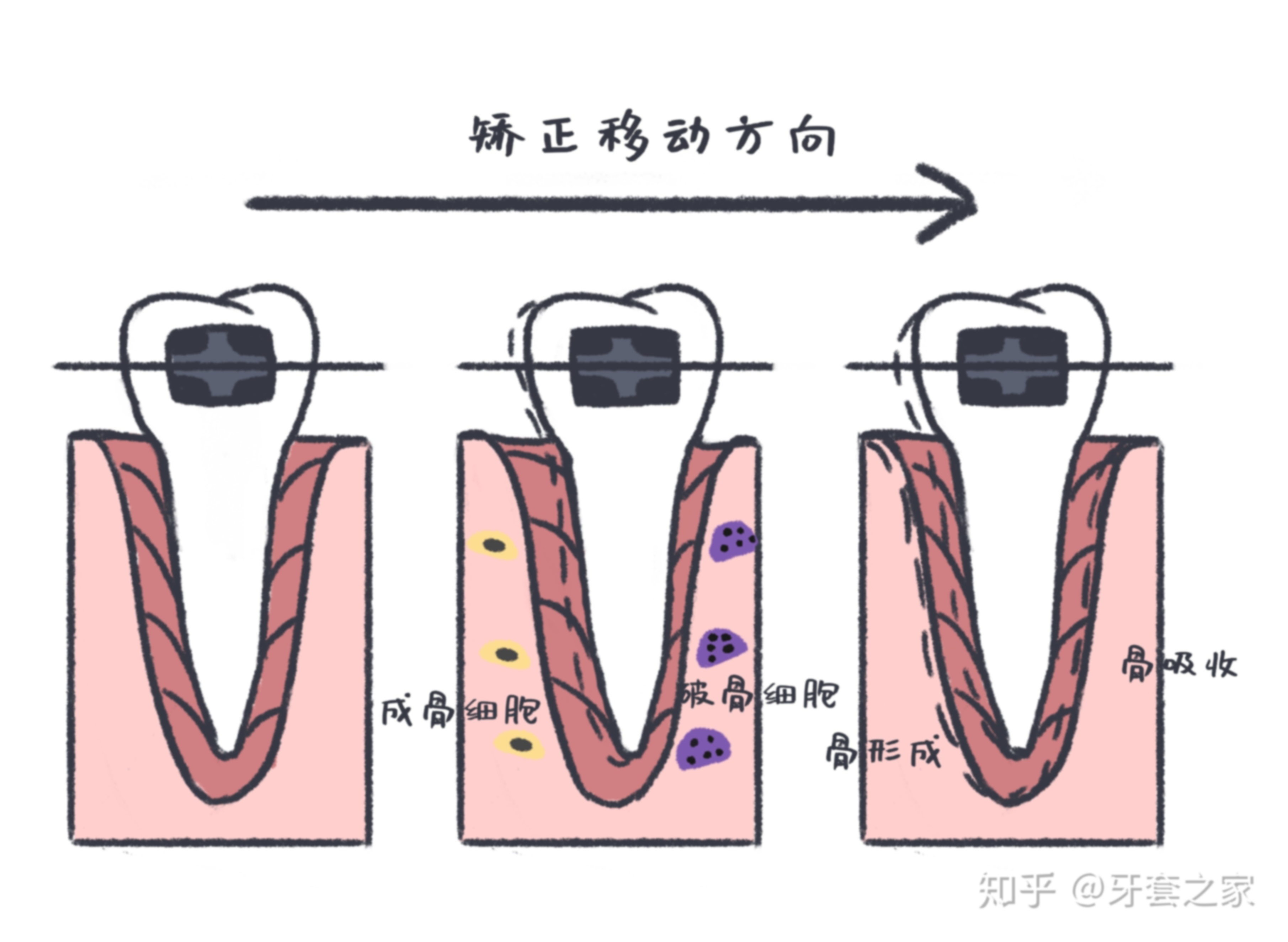 30多岁做牙齿矫正需要多长时间