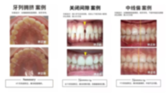 33岁深覆合可以矫正吗