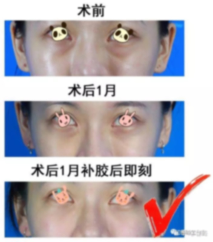 四十岁深覆合可以做矫正吗?