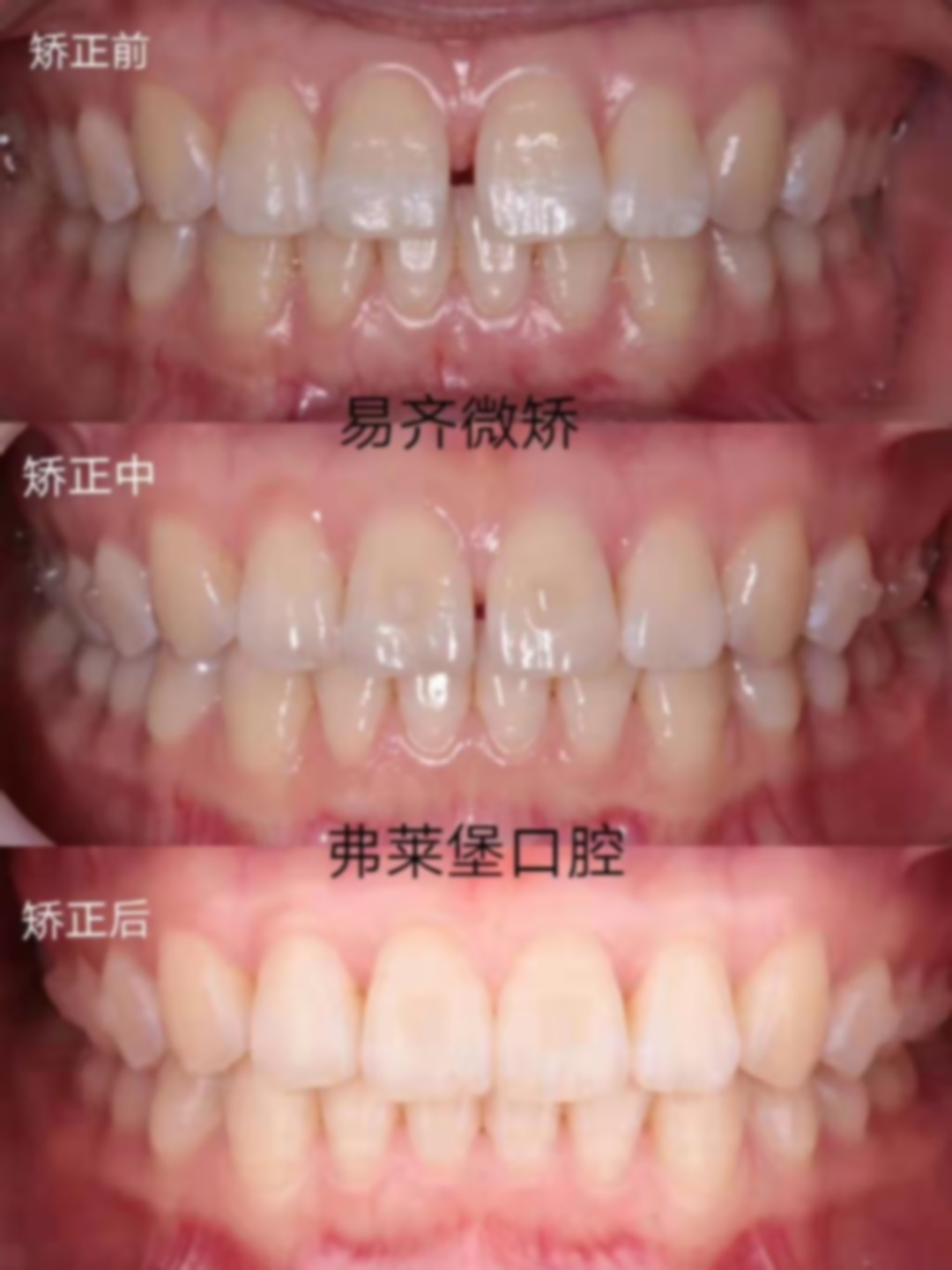 33岁做牙齿矫正后悔的吗