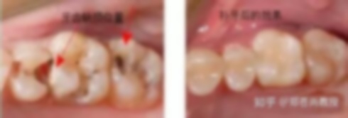 5岁儿童蛀牙洞千万不能补