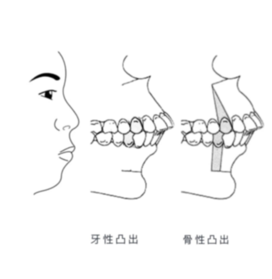 怎么改善凸嘴?