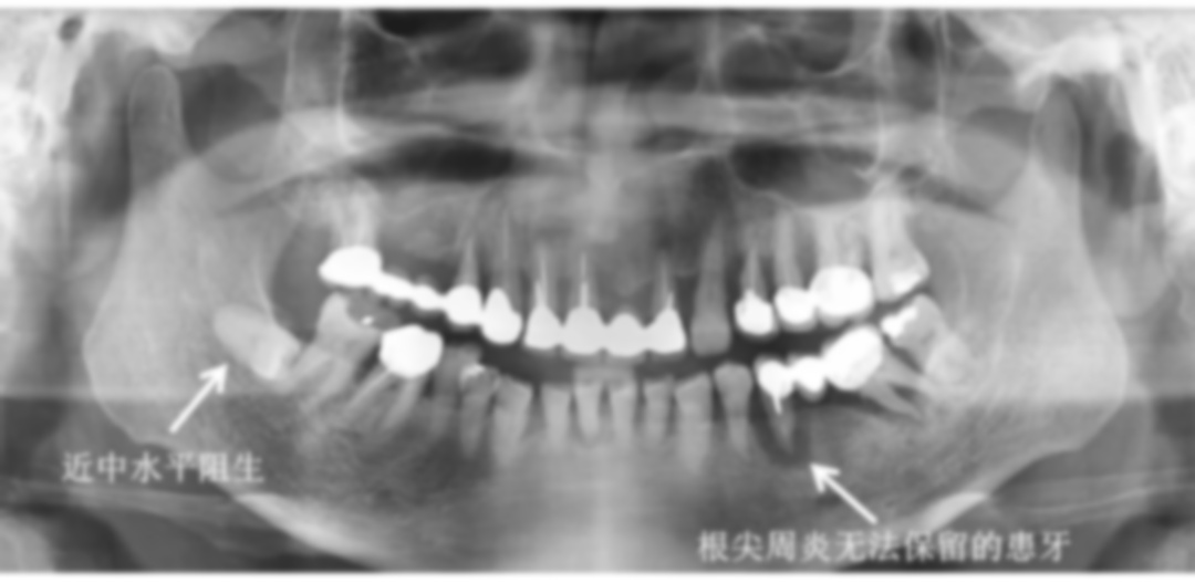 拔牙7天了还隐隐作痛可以输液吗