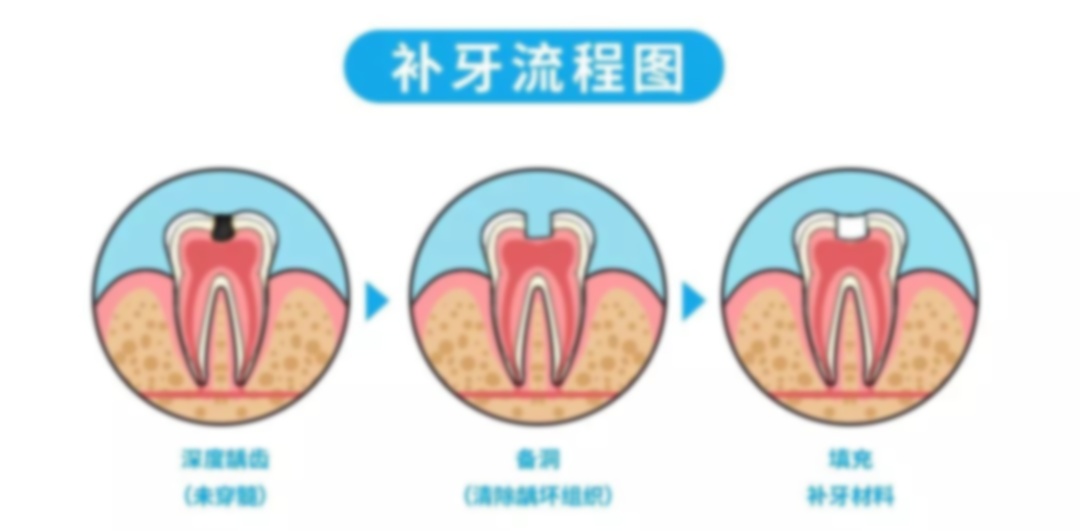 5岁儿童蛀牙洞千万不能补