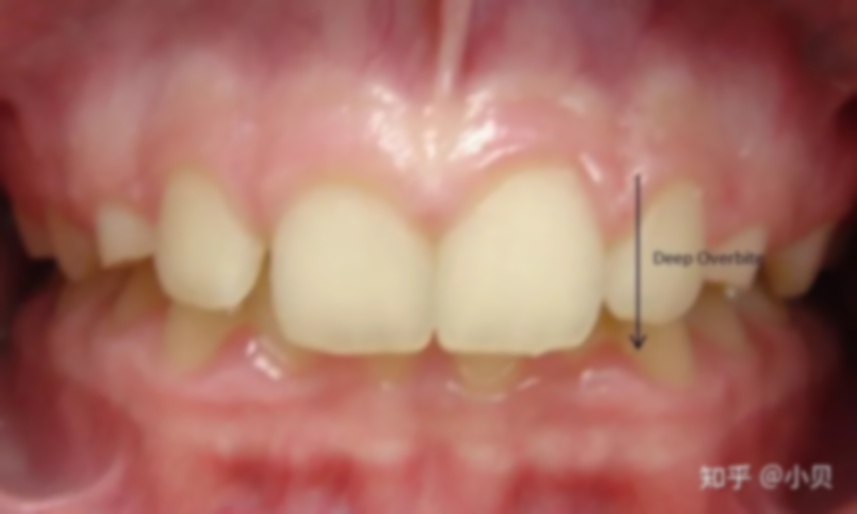 龅牙深覆合矫正