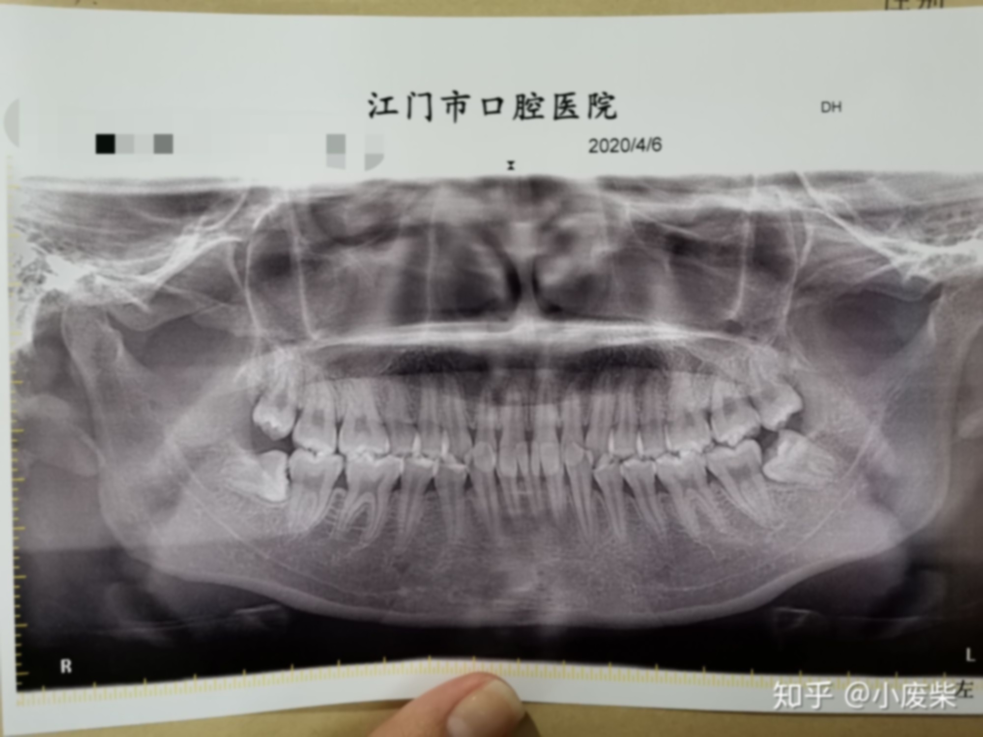 武大口腔拔智齿要花多少钱