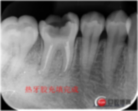 e-max铸瓷嵌体的价格