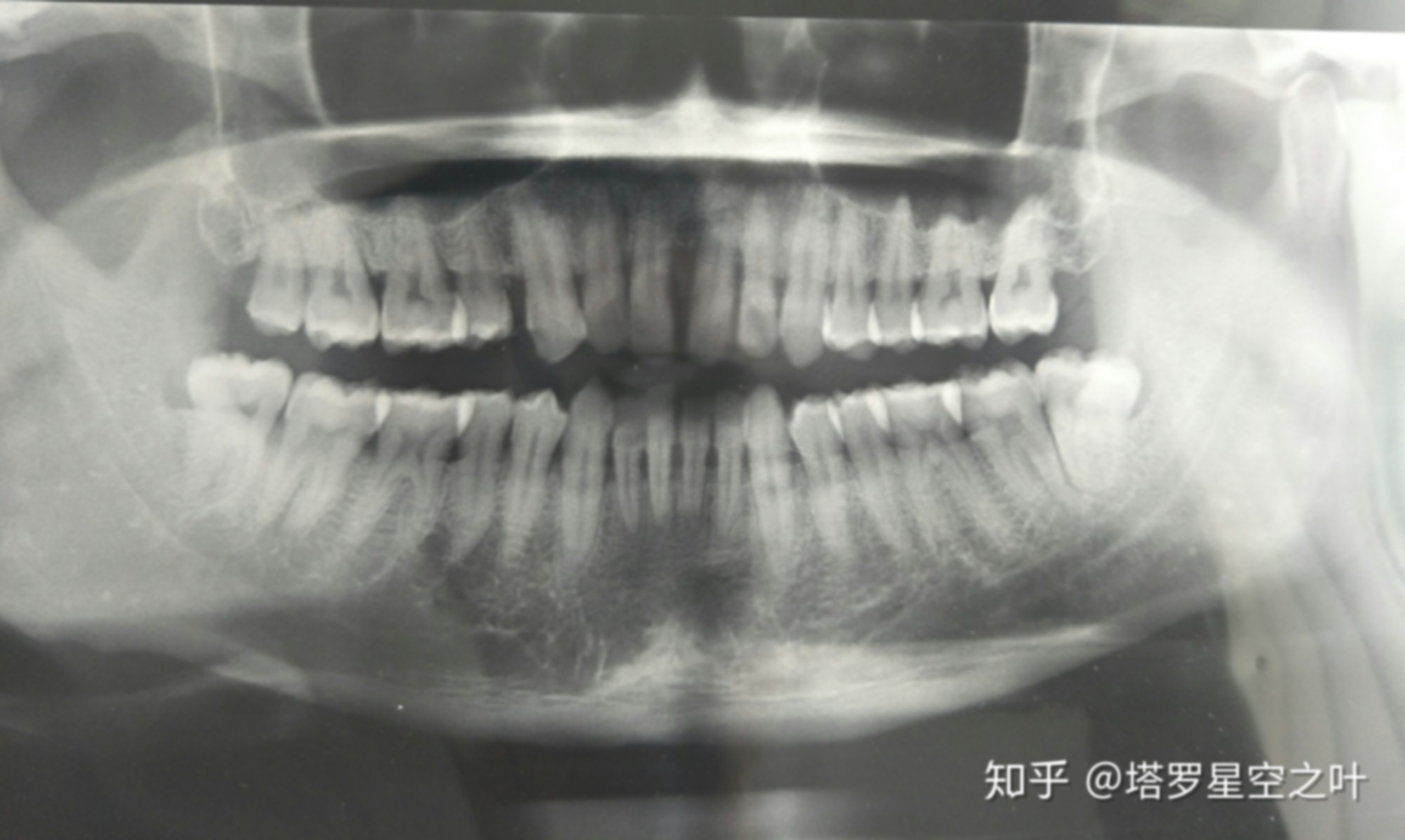 57岁牙齿掉了什么原因