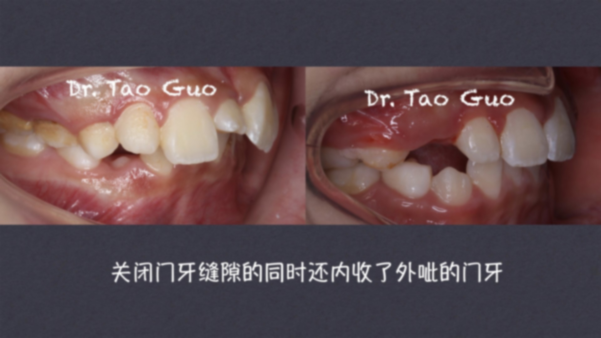 七岁小孩门牙缝隙大怎么办