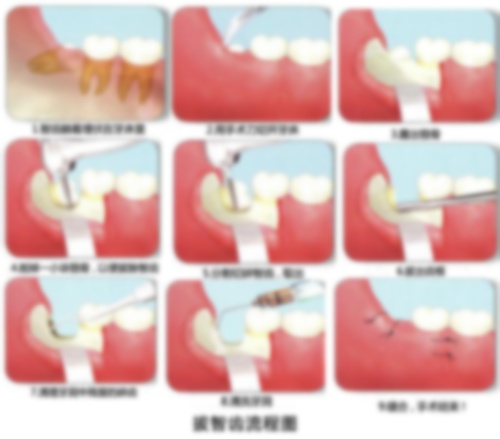 拔智齿拆线图片